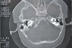 microtia-y-agenesia-conducto-auditivo-externo-acae-izq-tac-1998-017