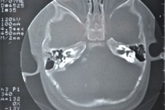 microtia-y-agenesia-conducto-auditivo-externo-acae-izq-tac-1998-018