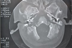 microtia-y-agenesia-conducto-auditivo-externo-acae-izq-tac-1998-019