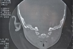 microtia-y-agenesia-conducto-auditivo-externo-acae-izq-tac-1998-021