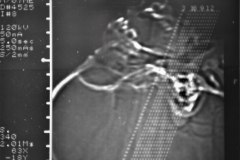 microtia-y-agenesia-conducto-auditivo-externo-acae-izq-tac-1998-022