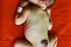 mielomeningocele-arnold-chiari-ii-1987-000