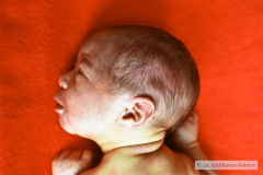 mielomeningocele-arnold-chiari-ii-1987-002