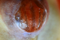 mielomeningocele-arnold-chiari-ii-1987-003