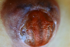mielomeningocele-arnold-chiari-ii-1987-004
