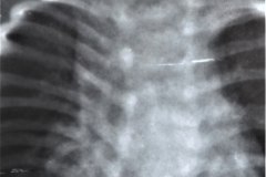 mielomeningocele-hidrocefalia-fractura-femur-izq-1992-000