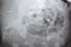 mielomeningocele-hidrocefalia-fractura-femur-izq-1992-001