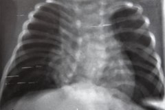 mielomeningocele-hidrocefalia-fractura-femur-izq-1992-002