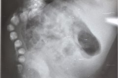 mielomeningocele-hidrocefalia-fractura-femur-izq-1992-003