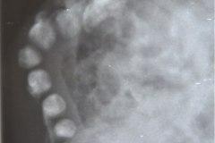 mielomeningocele-hidrocefalia-fractura-femur-izq-1992-004