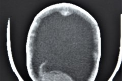 mielomeningocele-hidrocefalia-fractura-femur-izq-1992-006