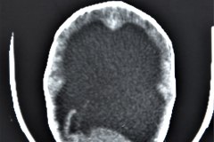 mielomeningocele-hidrocefalia-fractura-femur-izq-1992-007