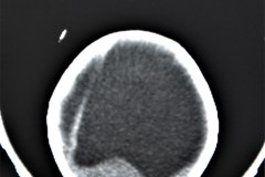 mielomeningocele-hidrocefalia-fractura-femur-izq-1992-009