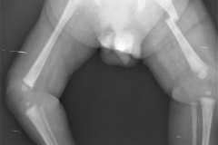 mielomeningocele-hidrocefalia-fractura-femur-izq-1992-011