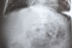 mielomeningocele-hidrocefalia-fractura-femur-izq-1992-012