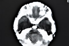 mielomeningocele-hidrocefalia-fractura-femur-izq-1992-013