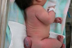mielomeningocele-lombosacro-esfinter-anal-hipotonico-2004-000