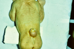 mielomeningocele-lumbar-1984-000