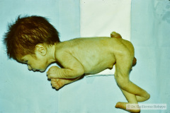 mielomeningocele-lumbar-1984-001