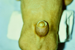 mielomeningocele-lumbar-1984-004