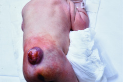 mielomeningocele-lumbar-esfinter-anal-atonico-004