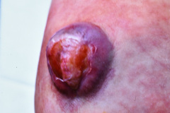 mielomeningocele-lumbar-esfinter-anal-atonico-005