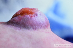 mielomeningocele-lumbar-esfinter-anal-atonico-006