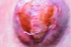 mielomeningocele-lumbar-esfinter-anal-atonico-007