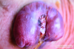 mielomeningocele-lumbar-esfinter-anal-tonico-004
