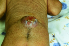 mielomeningocele-lumbar-001