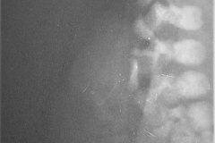 mielomeningocele-raquisquisis-hemivertebras-1992-000