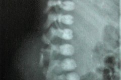 mielomeningocele-raquisquisis-hemivertebras-1992-001