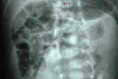 mielomeningocele-raquisquisis-hemivertebras-1992-003