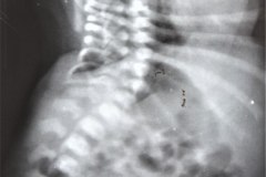 mielomeningocle-escoliosis-alteraciones-vertebrales-1989-001