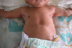 miliaria-cristalina-2002-000