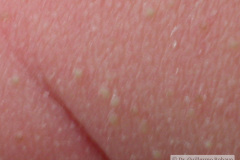 miliaria-cristalina-2006-001