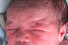 miliaria-cristalina-2006-002