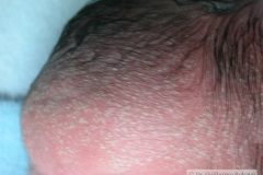 miliaria-cristalina-2006-003
