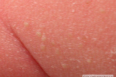 miliaria-cristalina-2006-005