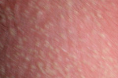 miliaria-cristalina-2006-006