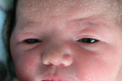 miliaria-cristalina-2006-010
