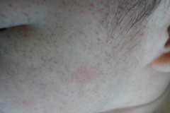miliaria-rubra-maculopapulas-purpuricas-petequiales-sarpullido-2005-007