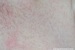 miliaria-rubra-maculopapulas-purpuricas-petequiales-sarpullido-2005-009