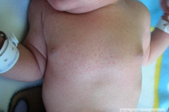 miliaria-rubra-maculopapulas-purpuricas-petequiales-sarpullido-2005-011
