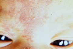 milio-millium-dorso-nasal-nevus-flameo-flammeus-frontal-001