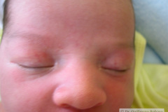 milio-millium-nasal-nevus-flameo-flammeus-palpebral-2009-000
