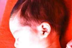 miller-disostosis-acrofacial-postaxial-hereditario1986-hermano-menor-001