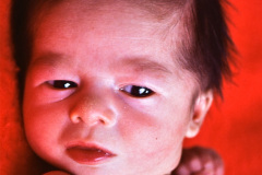 miller-disostosis-acrofacial-postaxial-hereditario1986-hermano-menor-006