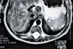 miofribromatosis-pulmonar-congenita-miofibromatosis-infantil-congenita-afectacion-viscera-unica-1997-000
