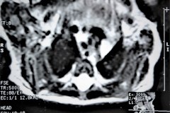 miofribromatosis-pulmonar-congenita-miofibromatosis-infantil-congenita-afectacion-viscera-unica-1997-002